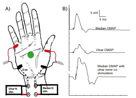 Median And Ulnar Motor Nerve Conduction Studies Recording Abductor