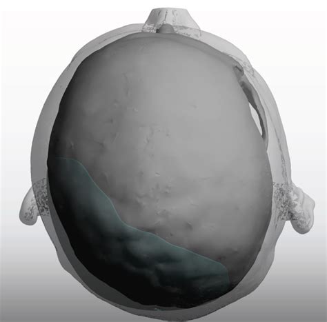 Left Plagiocephaly Skull Implant Top View Dr Barry Eppley Indianapolis