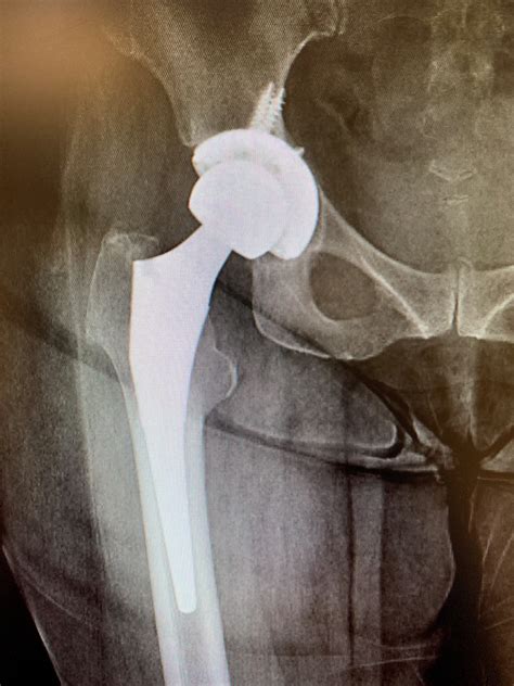 Case Study Revision Total Hip Replacement In A 64year Old Isolated