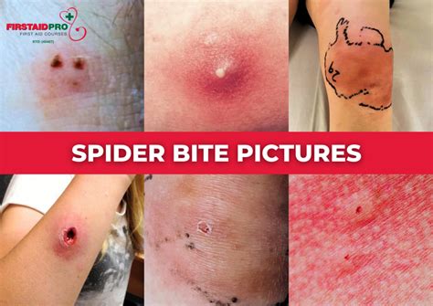 Spider Bites When To Worry Symptoms First Aid