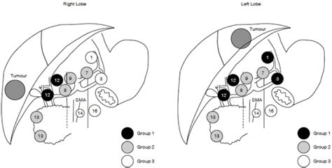 Grouping Of Regional Lymph Nodes According To The Classification Of