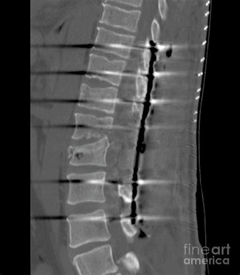 Spinal Fusion Surgery For Broken Back Photograph By Zephyr Science Photo Library