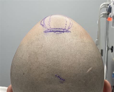 Plastic Surgery Case Study Surgical Technique For Anterior Sagittal