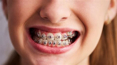 Invisible Braces Vs Metal Braces Which Is Better And Why Onlymyhealth