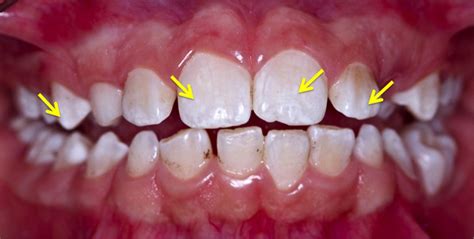 Removal Of Black Stains From Teeth By Photodynamic Therapy Clinical