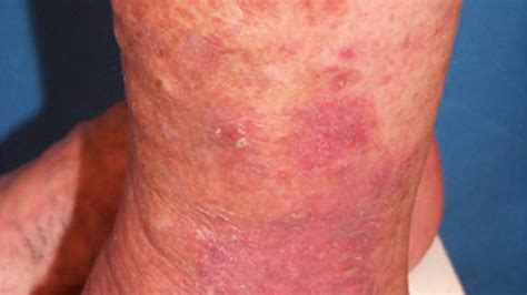 Types Of Eczema Identification Pictures And More