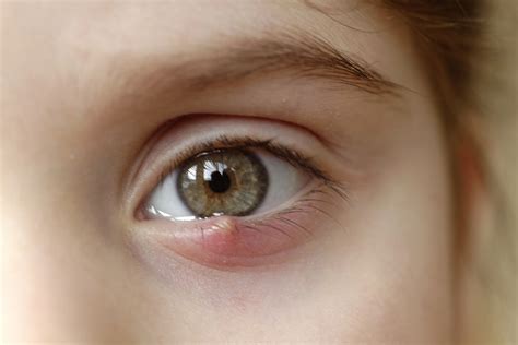 Stye Eye Causes And Treatment