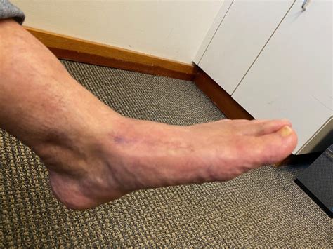 Midfoot Arthritis Paul H Kim Md