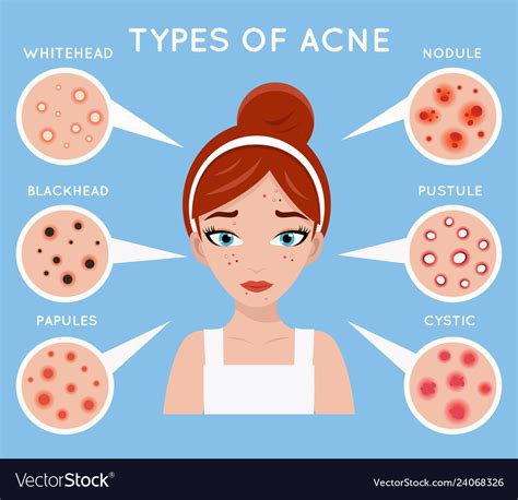 Face Acne Women Skin Cosmetic Care Pimple Problem Vector Image