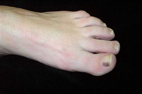 Toenail Melanoma Picture Pictures Photos