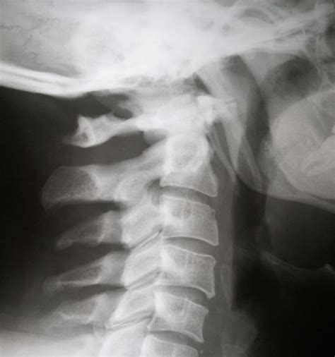 Radiografia De Cervicales