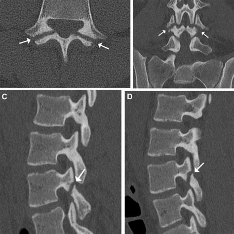 Right Sided Pars Interarticularis Defect At L3 Closed Arrow On Download Scientific Diagram