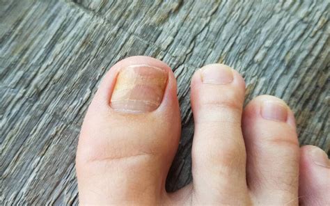 How Long Does It Take Your Toenail To Grow Back — River Podiatry I The Best Foot And Ankle Care