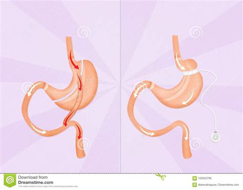 Gastric Bypass And Gastric Band Surgery Stock Illustration