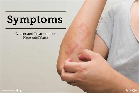 Symptoms Causes And Treatment For Keratosis Pilaris By Kaya Skin