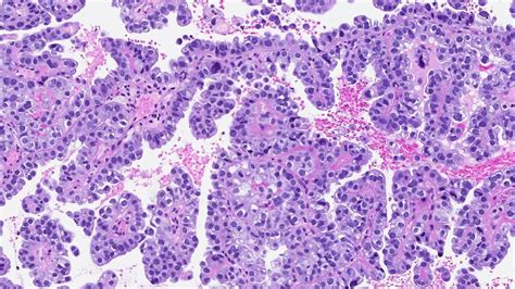 carcinoma endometrial de células claras mypathologyreport ca