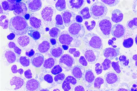 Chronic Myelomonocytic Leukemia Cmml Hematomorphology A Databank