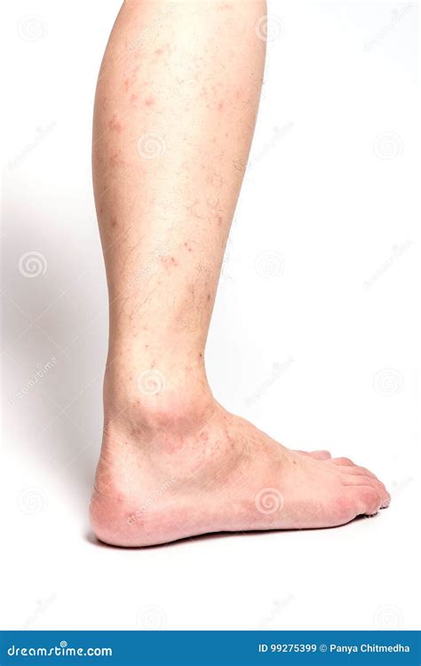 Allergic Rash Dermatitis Eczema Skin Of Patient Legs Stock Image