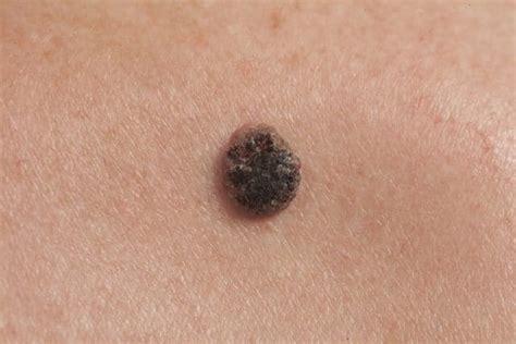 How To Tell If A Mole Is Cancerous Harris Dermatology