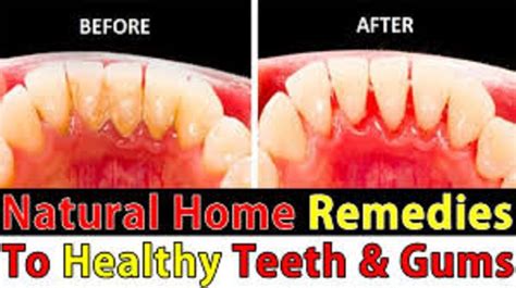 Sensitive Teeth Try Home Remedies For Fast Relief Dgs Health