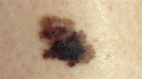 This Is What Melanoma Skin Cancer Looks Like Huffpost Uk Life