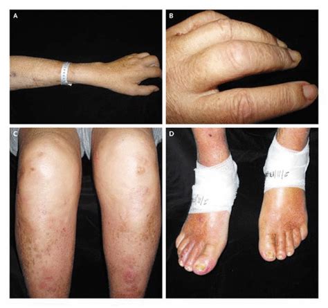 It's a serious and worrisome condition. Case 35-2004 — A 68-Year-Old Man with End-Stage Renal ...