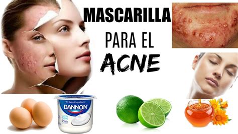 Como Eliminar El Acne Al Instante Remedio Casero Youtube