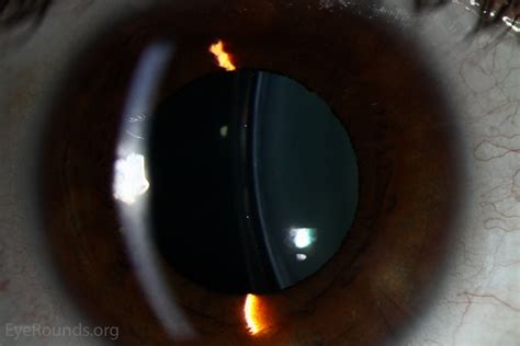 Atlas Entry Visian Implantable Collamer Lens Icl Implant