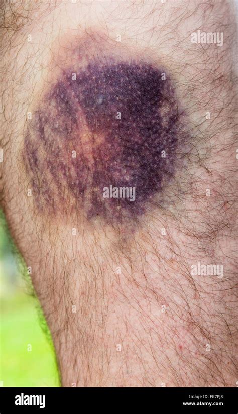 Bruised Leg High Resolution Stock Photography And Images Alamy