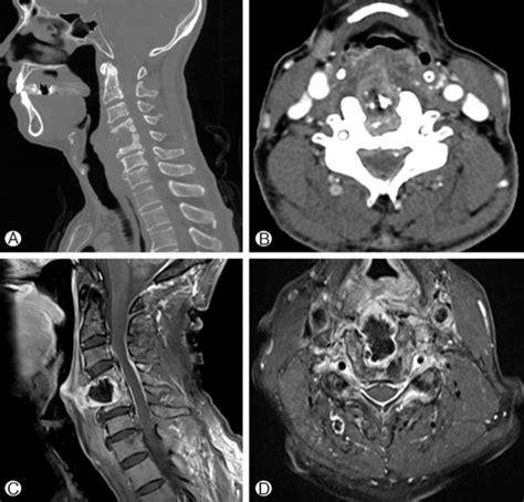 Cervical Spine Ct Images Demonstrating Osteolytic Lesion In C4 And C5