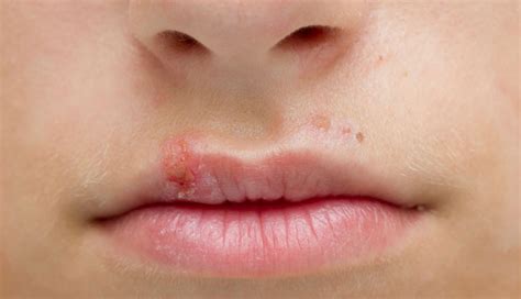 Determining The Cause Of A Refractory Lip Blister Clinical Advisor