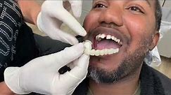 Houston Cosmetic Dentist ...How to close those gaps without braces affordably!!