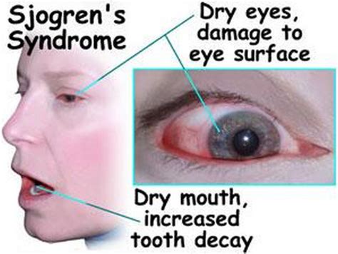 Sjogrens Syndrome Pictures