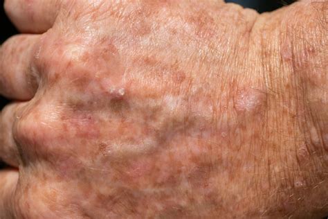 Por Qué Necesita Tratar La Queratosis Actínica Heymann Manders