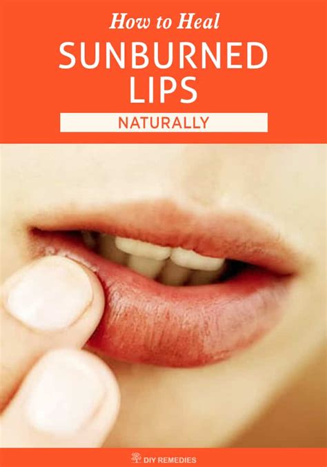 How To Heal Sunburned Lips Naturally