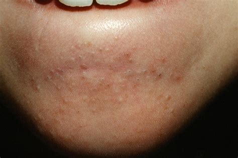 Tumbuhnya acne di area ini biasanya disebabkan oleh ketidakseimbangan kadar hormon yang sering naik dan turun, terutama ketika menstruasi. Jerawat di dagu? Aduh sakitnya! Ini cara menghilangkan ...