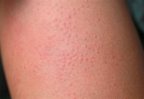 Close Up Allergic Rash Dermatitis Eczema On Skin Stock Photo Image Of