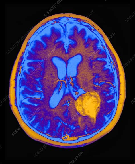 Benign Brain Tumour Mri Scan Stock Image C0147063 Science Photo