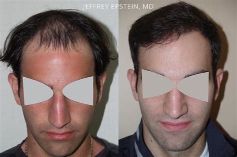 Hair Transplants For Men Photos Miami FL Patient37625