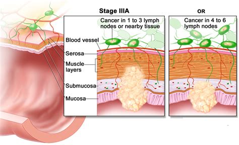 Colon Cancer Causes Signs Symptoms Stages Screening And Treatment