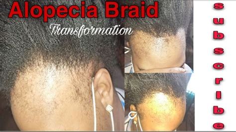 76 Amazing Front Hairline Alopecia Transformation 👏🏽😍 Alopecia