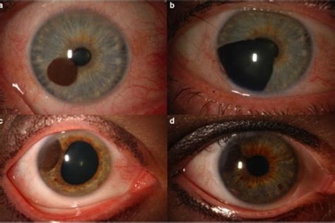 Eye Melanoma Or Ocular Melanoma The Eye News