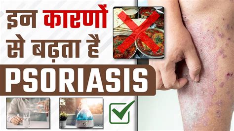 Psoriasis क्यों बढ़ता है Tips To Relief In Psoriasis Dr Health Dr Megha Chaturvedi Youtube
