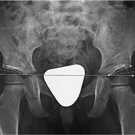 supine pelvic radiograph shows bilateral ddh with the acetabular index download scientific