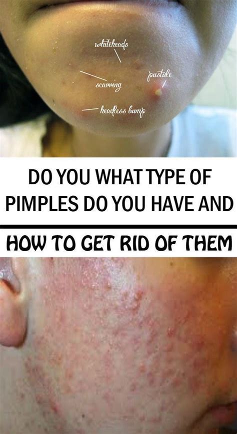 Pimples Are An Annoyance And Some Are Harder To Recuperate Than Other