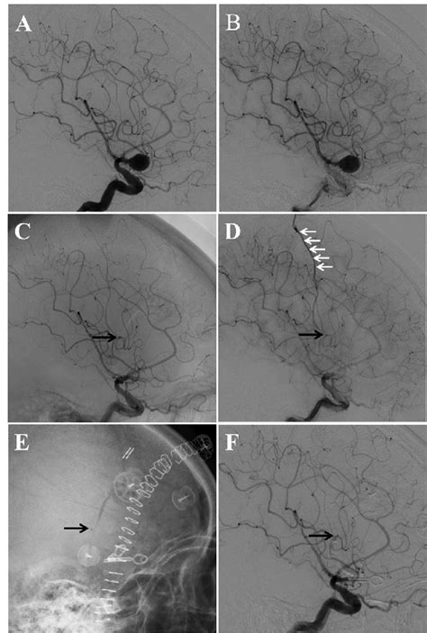 A B Preoperative Cerebral Angiography Showed A Right Middle Cerebral