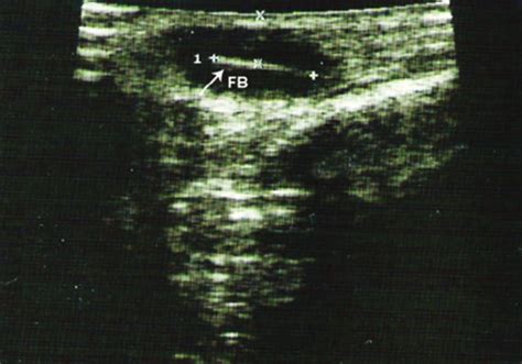 Ultrasound Scan Fb 11 Mm Lying 5 Mm Deep To Skin Granuloma Measuring