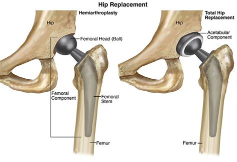 Choosing A Best Hip Replacement Implants Dr Santosh Shetty