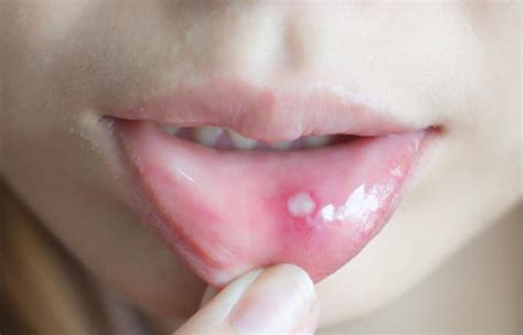 15 Canker Sore Relief Remedies That Work