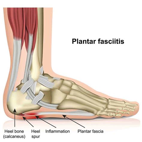 Heel Pain Plantar Fasciitis Causes Treatments And Prevention